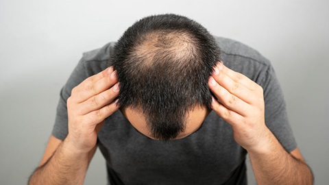 Tout savoir sur le Finastéride contre la chute des cheveux